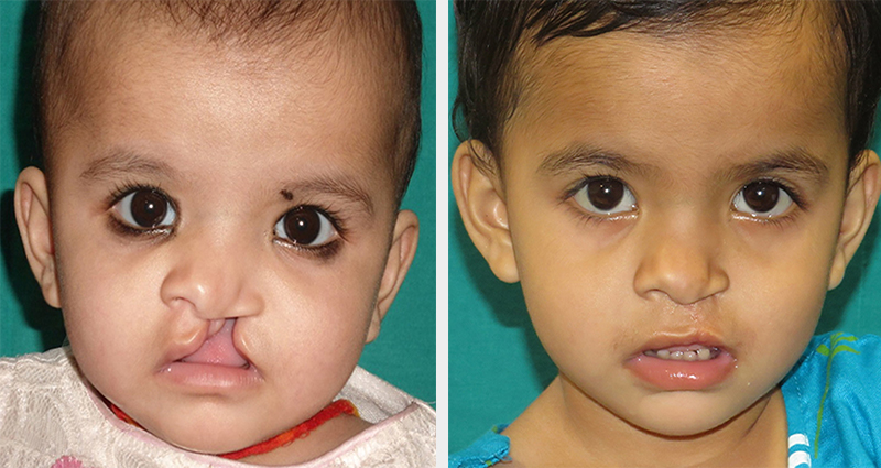 Care for Persons with Facial Cleft/Cleft Pre to Post
