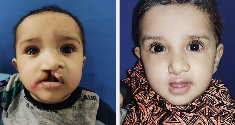 Health- Care for Persons with Facial Cleft/Cleft Pre to Post varad Joshi