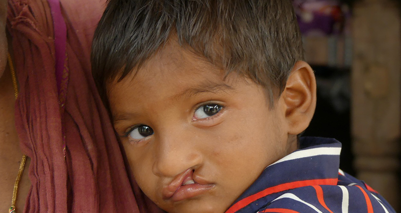 Health Facial Cleft Program