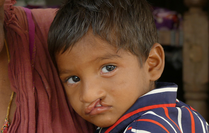 Care for Persons with Facial Cleft/Cleft Palate