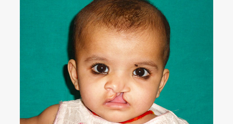 Facial Cleft