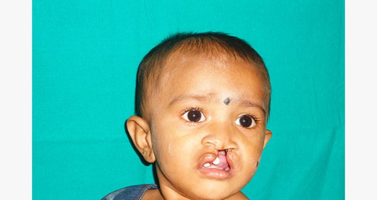 Facial Cleft